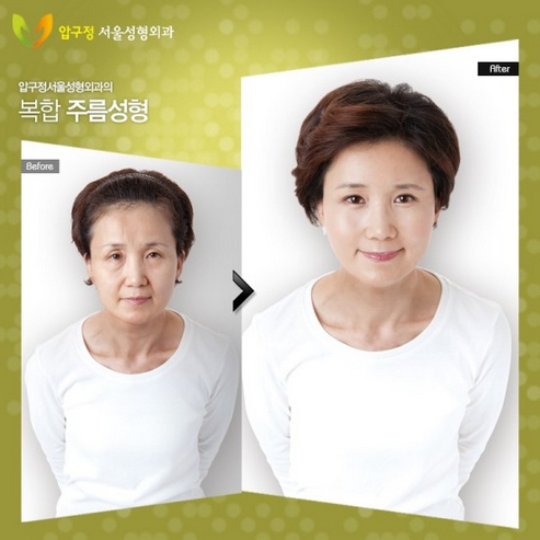 31張韓國高超整容手術前後照　你有心動嗎？